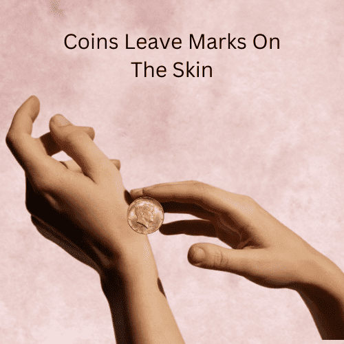 Coins Leave Marks On The Skin