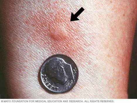Coin mark on skin